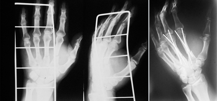 Osteosinteza Kirschnerovim žicama